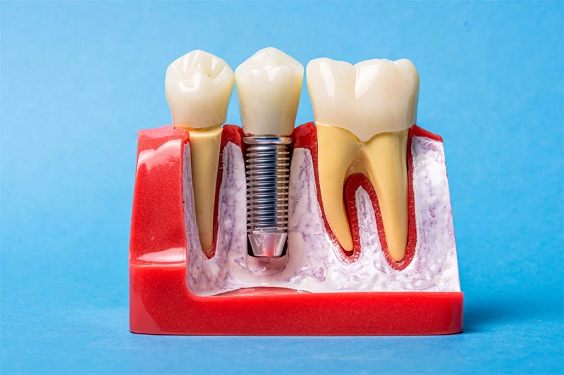 Dental Implants